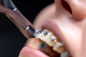 Aparat dentar metalic