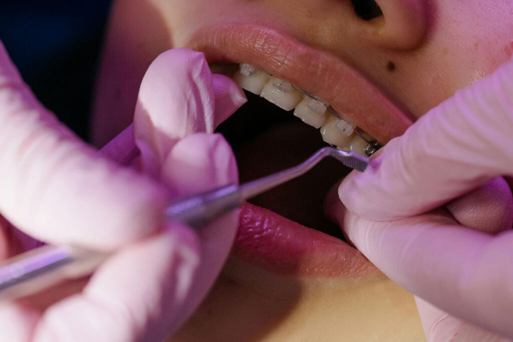 Cat Costa Un Aparat Dentar