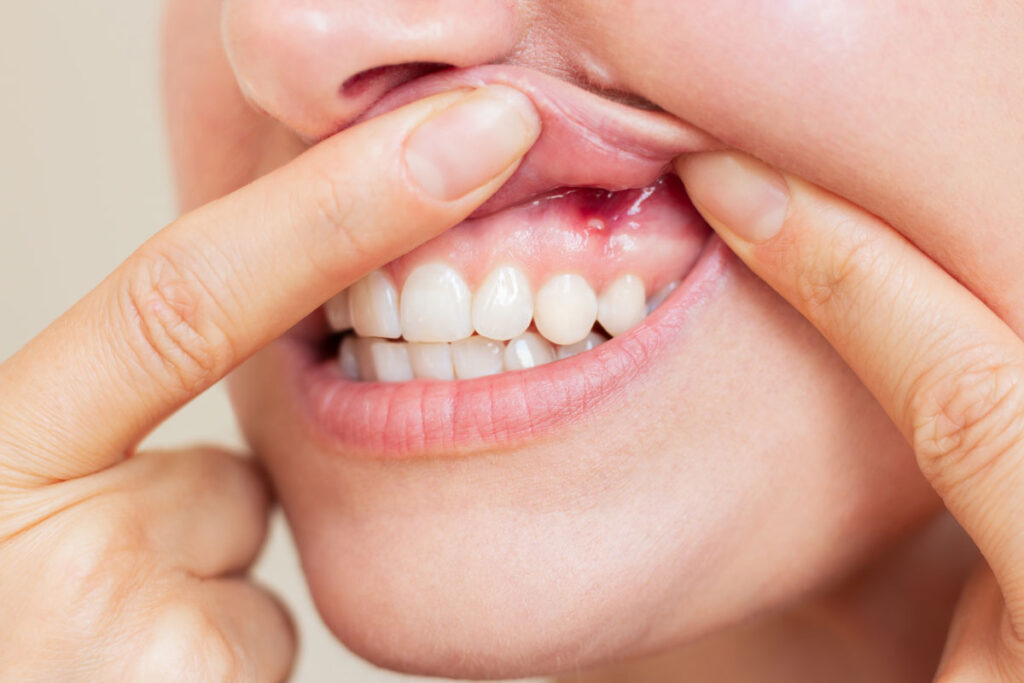 Chiuretaj Subgingival