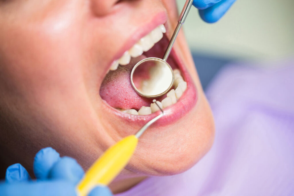 Chiuretaj Subgingival