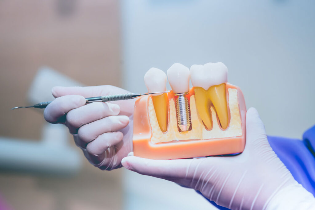 Recuperarea Dupa Implant Dentar